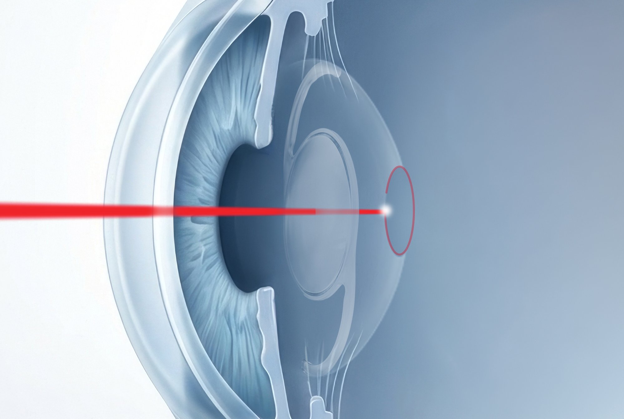 PosteriorCapsulotomy